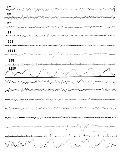EEG patterns of RPS in man