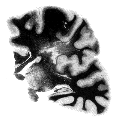 Brain lesion in a case of prolongedunconsciousness